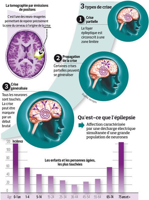 épilepsie les résultats intéressants de la chirurgie